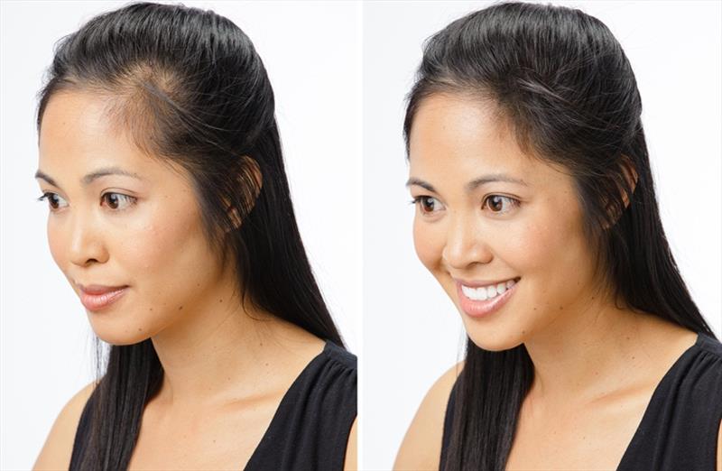 20 Off On Hair Weaving Bonding Sharvi S Aesthetic Clinic