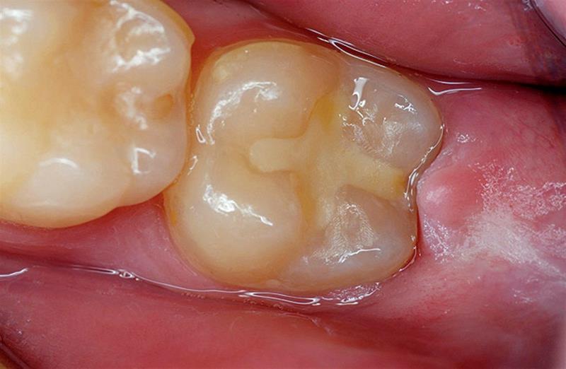 gic tooth filling