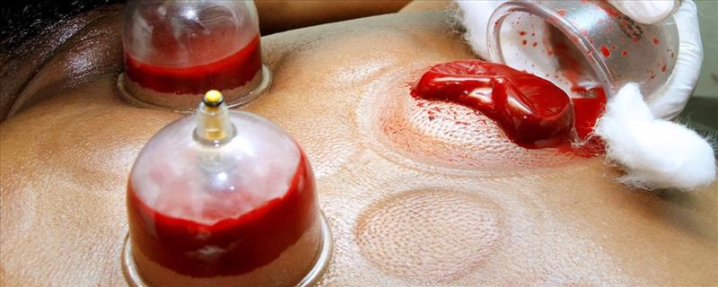 Hijama Therapy (Cupping Therapy) + Doctor Consultation