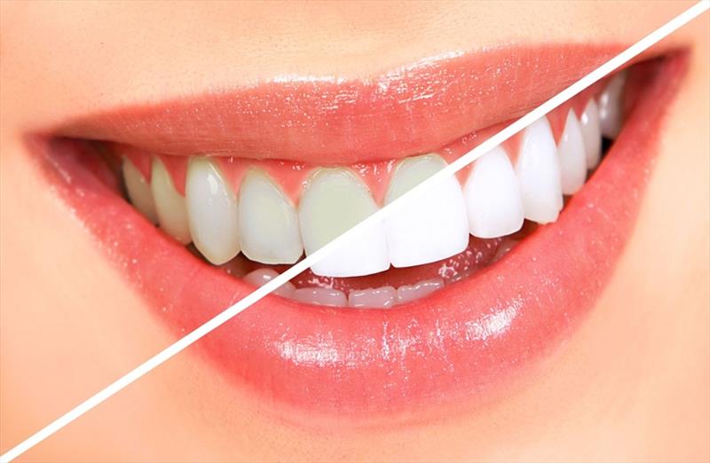 Teeth Scaling & Polishing